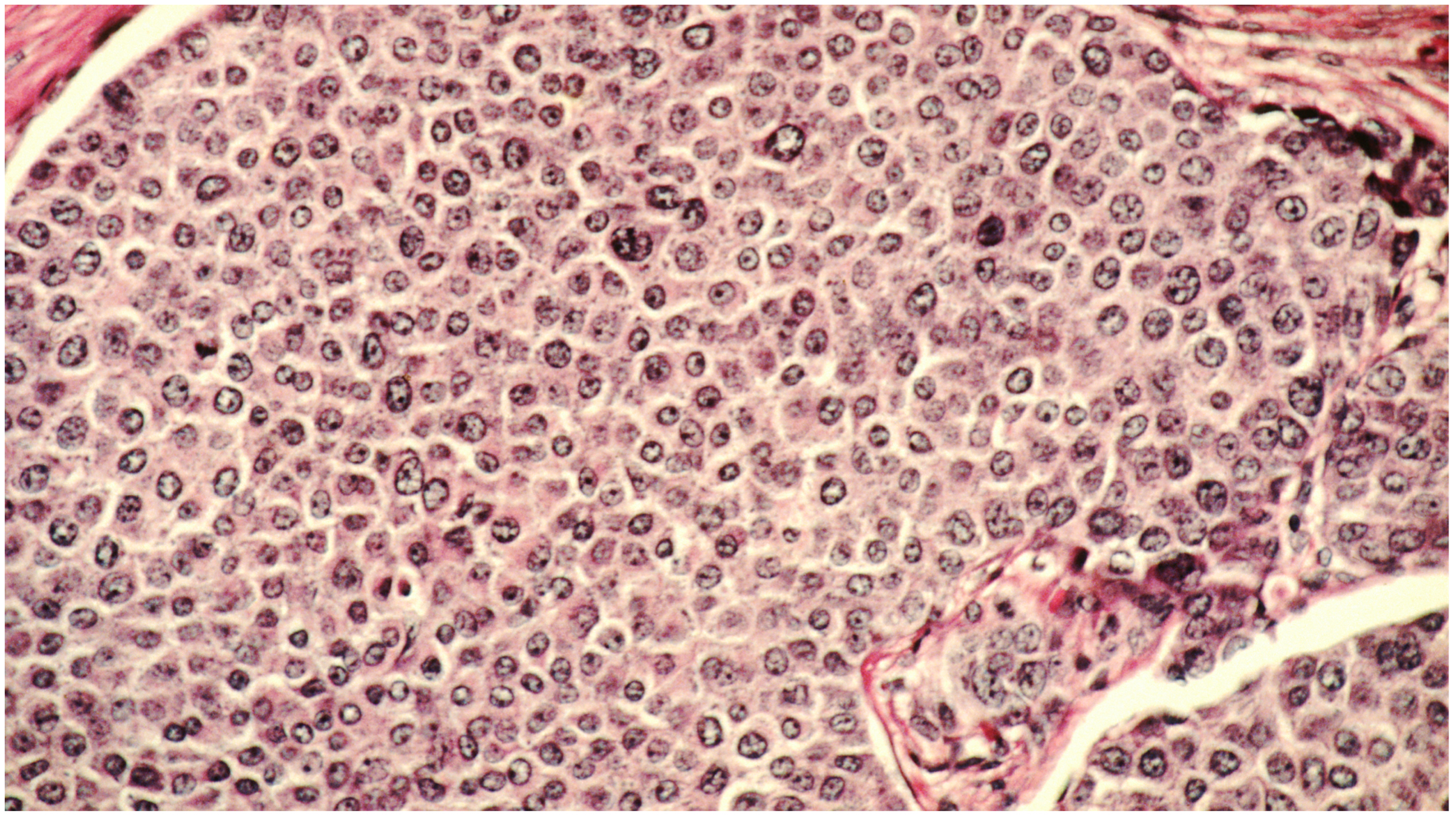 New Lab Test Can Predict Spread Of Breast Cancer Cells